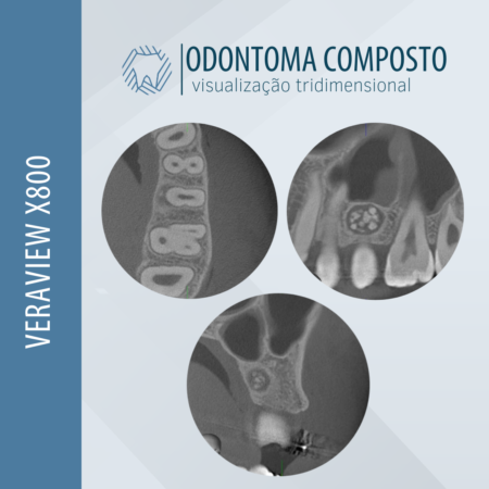 odontoma-composto-visualizacao-3d-veraview-x800