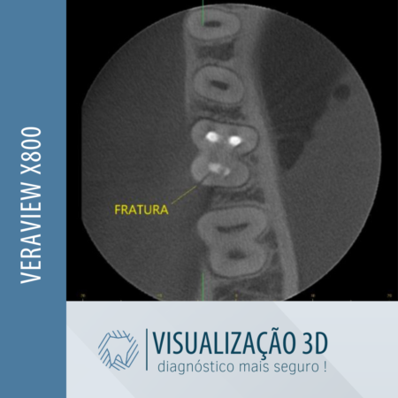 tomografo-veraviewx800-diagnostico-odontologico-seguro
