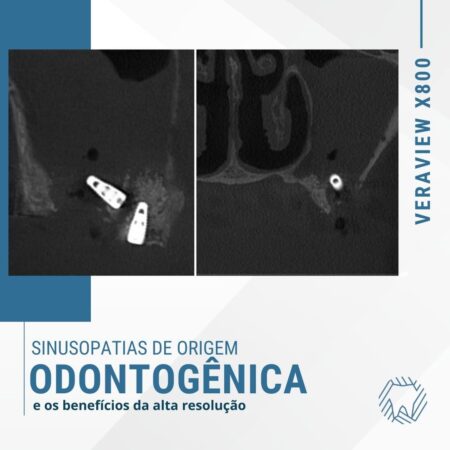 sinusopatia-odontogenica