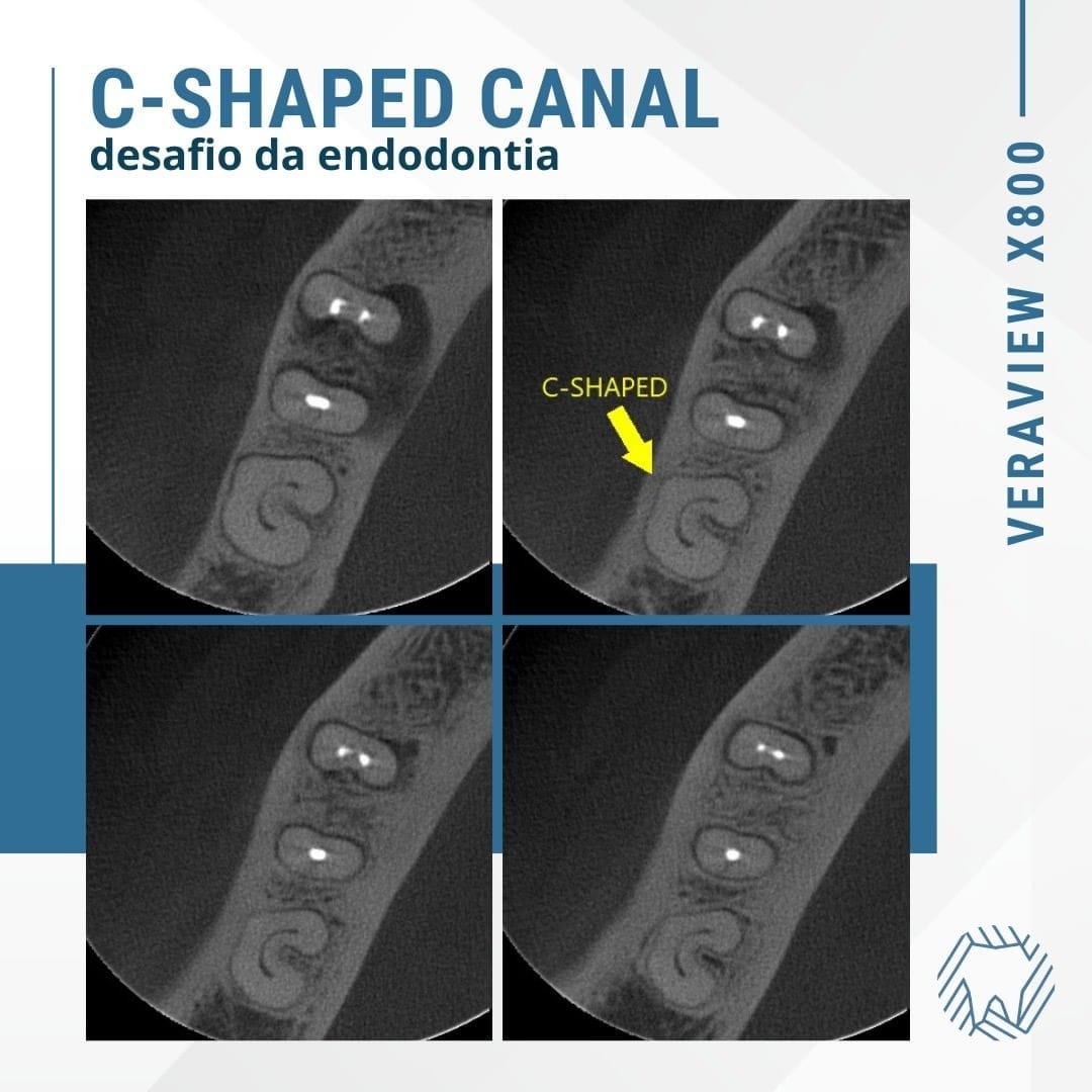 c-shaped-canal