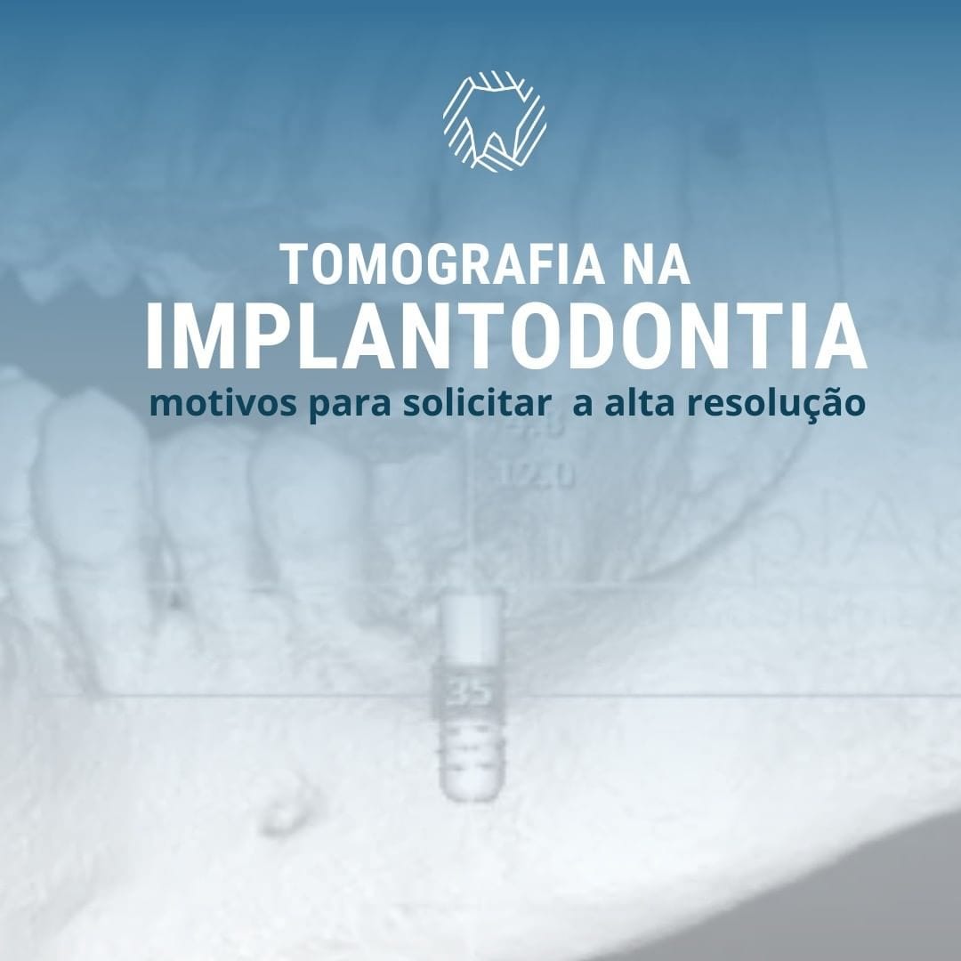 tomografia-na-implantodontia