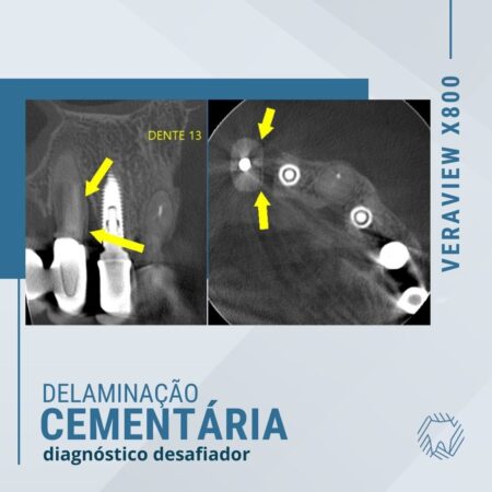delaminacao-sementaria