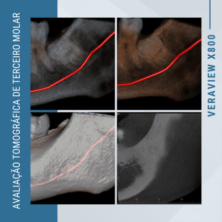avaliacao-tomografica-de-terceiro-molar