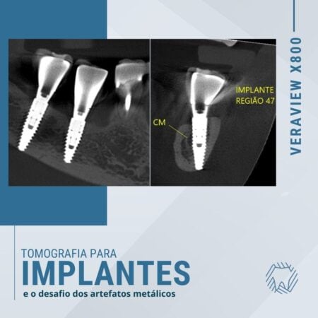 tomografia-para-implantes