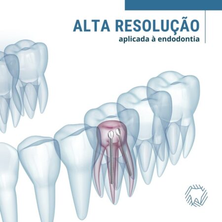 alta-resolucao-endodontia