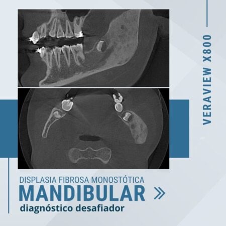 displasia-fibrosa-monostotica