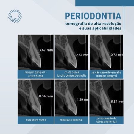 tomografia-de-alta-resolucao