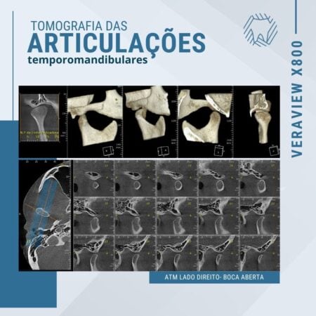 articulacoes-temporomandibulares