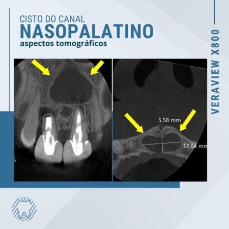 cisto-do-canal-nasopalatino