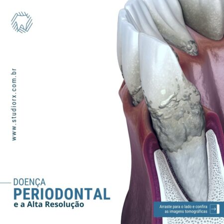 doenca-periodontal-e-alta-resolucao