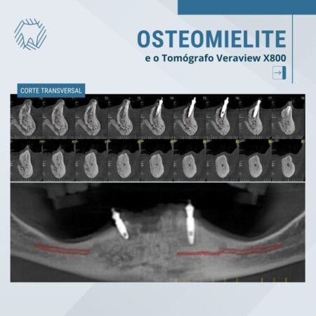 osteomielite