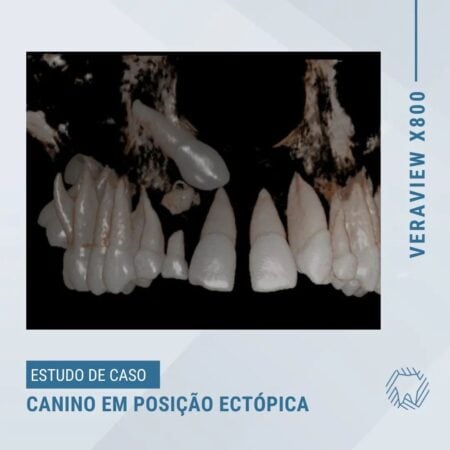 canino-em-posicao-ectopica