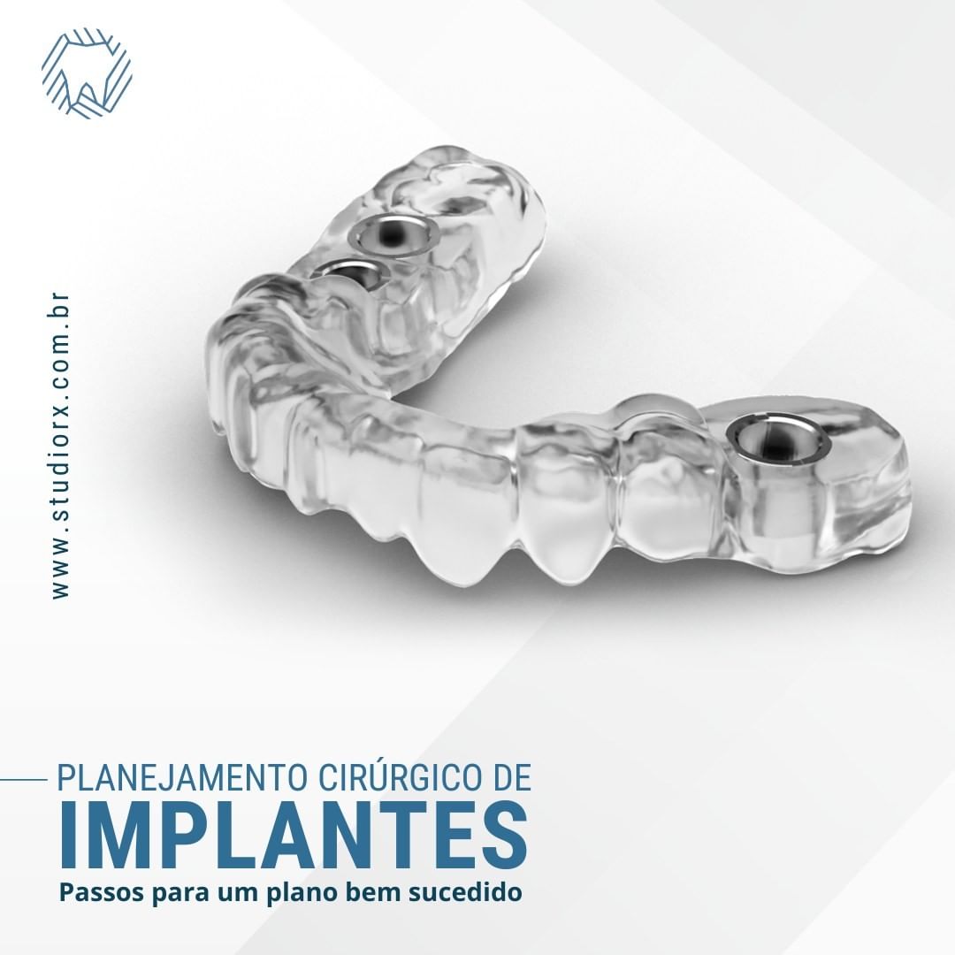 planejamento-cirurgico-de-implantes