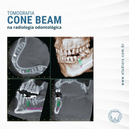tomografia-cone-beam