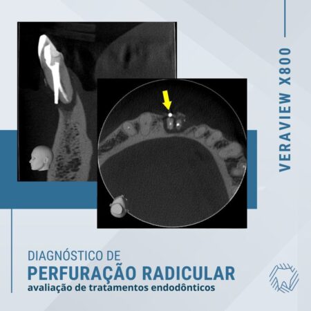 perfuração-radicular
