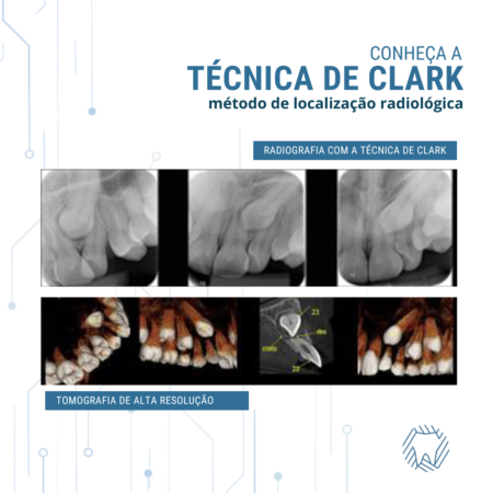 técnica-de-clark