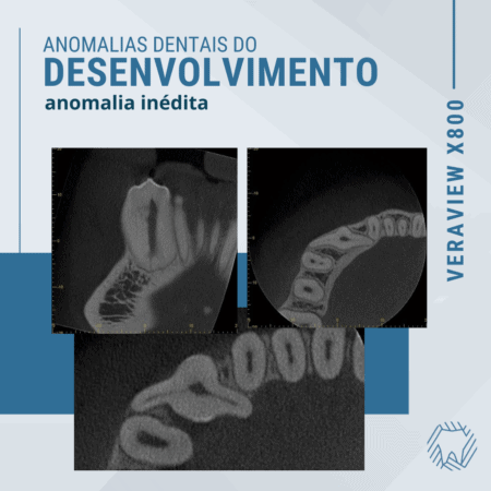 anomalias-dentais-do-desenvolvimento