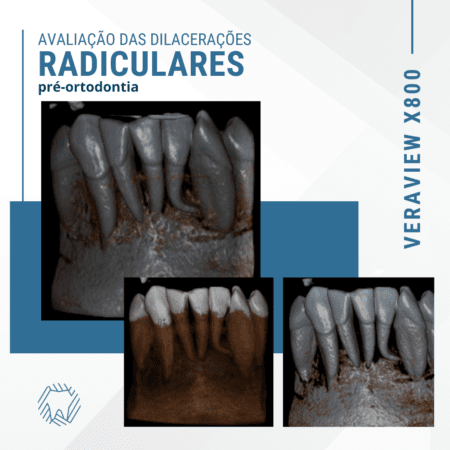 dilacerações-radiculares