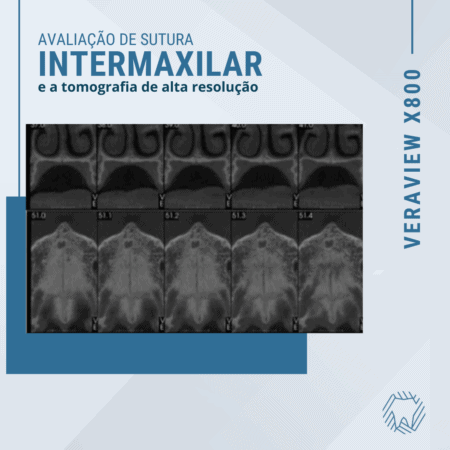 sutura-intrermaxilar