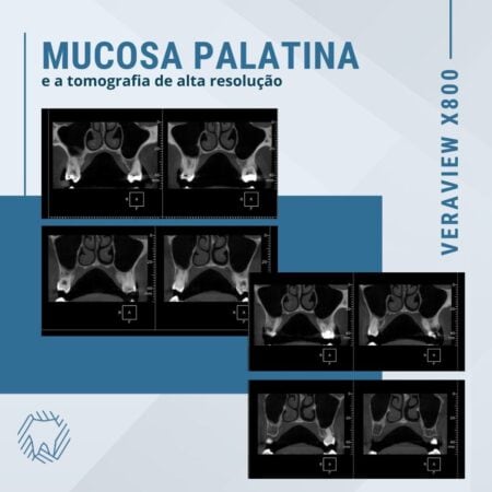 mucosa-palatina-e-tomografia-de-alta-resolução