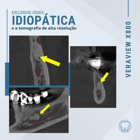 esclerose-óssea-idiopática