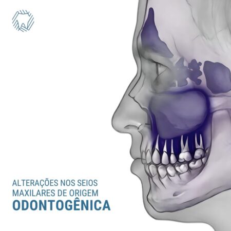 A sinusite de origem odontogênica pode levar a um tratamento ineficaz e a sua reincidência