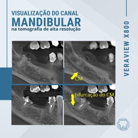 Visualização do canal mandibular