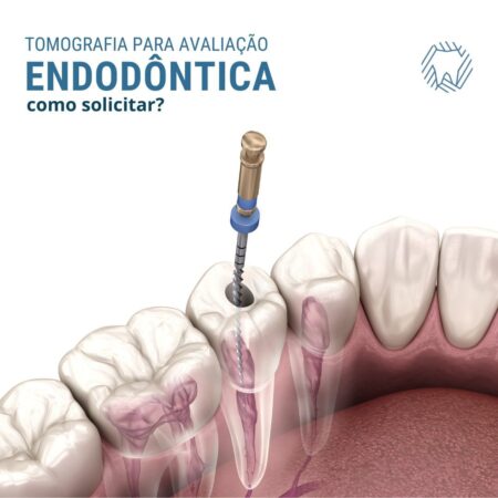 É comum solicitar de maneira incorreta a tomografia para finalidade endodôntica