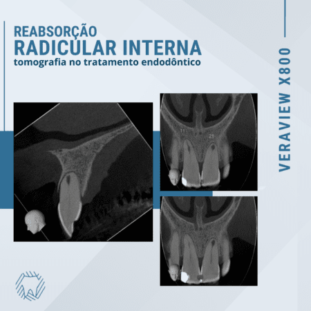 Exame de tomografia para tratamento endodôntico