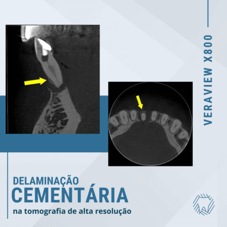 Delaminação cementária identificada através da tomografia de alta resolução