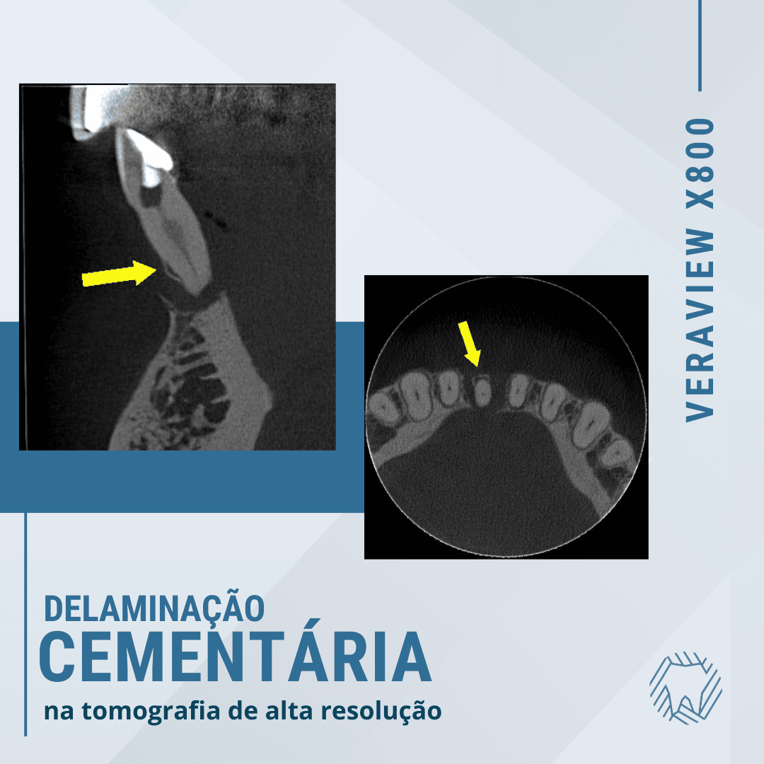 Delaminação cementária identificada através da tomografia de alta resolução