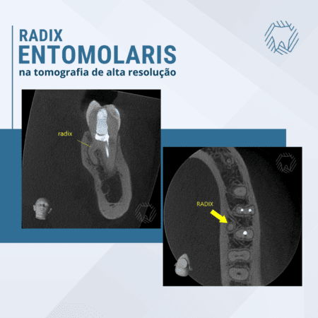 Imagens tomográficas de Radix Entomolaris