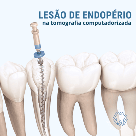 Ilustração de instrumento semelhante a uma broca perfurando um dente e chegando à raiz