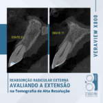 Reabsorção radicular externa avaliando a extensão na tomografia de alta resolução